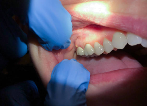 Best Chipped Tooth Repair Near Me  in Carrollton, TX